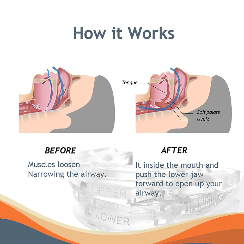 Anti-Snoring Mouth Guard for Bruxism and Sleep Apnea
